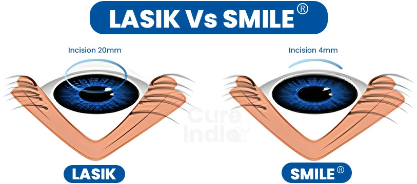 SMILE vs. LASIK eye surgery in India